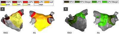 Local Electrical Impedance Mapping of the Atria: Conclusions on Substrate Properties and Confounding Factors